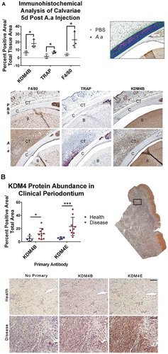 Figure 1. KDM4B abundance is significantly increased in periodontal diseased versus healthy tissues. Live Aa was injected subcutaneously into 12-week old C57BL/6 mice at the mid-sagittal region of the calvarium every day for 5d. Paraffin embedded sections were stained for F4/80, TRAP and KDM4B using immunohistochemistry, all of which were significantly upregulated in diseased versus healthy calvariae. 10x Images presented are representative of the data set. (a) In clinical periodontal specimens, the region of interest was defined as the connective tissue underlying the oral epithelium. Paraffin embedded sections were stained for KDM4E and KDM4B using immunohistochemistry, both of which were upregulated in diseased versus healthy patient tissues. 20x images are representative of the data set. (b) positive pixels quantified using color thresholding in imagej. Data are presented as mean ± SD. Significance was determined using a one-tailed Wilcoxon ranked sum test. Epithelium (E) Calvarial Bone (C) Brain (B) *P < 0.05, ***P < 0.001. Scale bars, 100 μm.