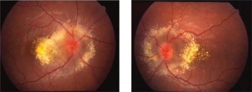 Figure 2 Fundus photos demonstrates bilateral optic disc edema and extensive circumferential exudation with macular involvement and macular star formation.