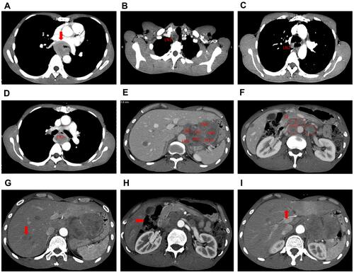 Figure 2 Chest and abdominal contrast-enhanced CT images at diagnosis. (A) Primary esophageal tumor in the middle/lower third of the esophagus. As can be seen at the red arrow, the wall of the esophagus was thickened, with the whole layer being infiltrated, and the boundary was clear, which means T3 according to TNM stage criteria of the Union for International Cancer Control (UICC). (B–E) Regional enlarged lymph nodes (LN): more than seven regional metastatic lymph nodes means N3 according to TNM stage criteria of UICC. (F) The red circles indicated metastatic lymph nodes in the abdominal cavity and retroperitoneum (M: metastasis). (G–I) The red arrow indicated liver metastatic nodes.