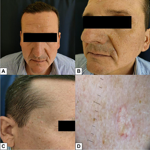 Figure 9 Eruptive yellowish papules located on face and forehead. (A–C). Lesions on the forehead and the cheeks. (D). Dermoscopy showing the presence of well-demarcated yellow globule structures, divided by septa constituted by focused reddish capillaries.