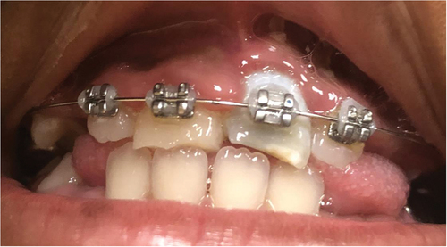 Figure 13. Intraoral photo one year since initial injury. Gingival inflammation and uneven gingival zenith noted.