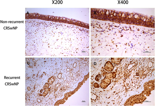 Figure 7 The ALCAM protein expression in the nasal polyps tissue based on IHC. Representative images of ALCAM staining from non-recurrent CRSwNP patients (A and B) and recurrent CRSwNP patients (C and D).