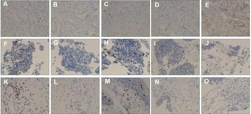 Figure 4 IHC staining for the patient’s tissue samples. (A–E) Lung squamous carcinoma staining for CD3, CD4, CD8, PD-1 and PD-L1, respectively. (F–J) Small cell lung cancer biopsy sample staining for CD3, CD4, CD8, PD-1 and PD-L1, respectively. (K–O) Urothelium biopsy staining for CD3, CD4, CD8, PD-1 and PD-L1, respectively.