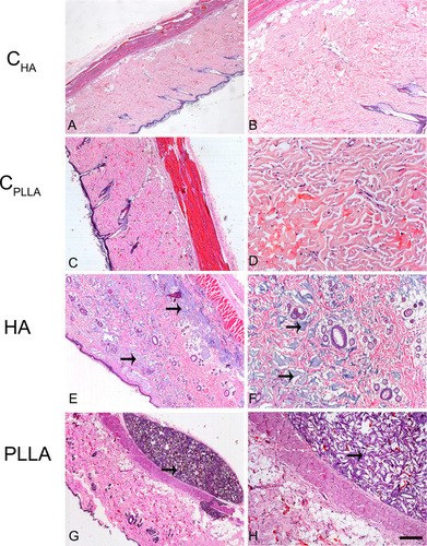 Figure 3 Photomicrograph of dermal skin biopsies after 30 days of dermal injection of PBS (control for HA: A and B), distilled water (control for PLLA: C and D), HA (E and F), and PLLA (G and H). Arrows indicate the presence of dermal filler. Scale: (A, C, E and G)= 500 μm; (B, D, F and H)= 200 μm.