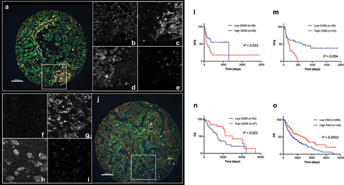 Figure 3. Validation of CD95 as an indicative immune marker for immunotherapy in melanoma identified by DSP. A, J) Two representative images of CD95 expression on melanoma tissue (CD95: red; S100B (melanocytes): green; CD45 (pan-leukocyte): yellow; CD68 (macrophages): cyan; nuclei: blue). (B–E) and (F–I) are regions from images A and J, respectively, showing CD95 (B, F), CD45 (C, G), S100B (D, H), and CD68 (E, I) in white. Kaplan–Meier survival curves showing: (L) PFS for CD95 protein quantified in CD68 compartment by QIF in discovery ITX cohort YTMA469 (cutoff point: median); (M) PFS for CD95 protein measured in stroma by QIF in validation ITX cohort YTMA376 (cutoff point: top tertile); (N) OS for CD95 protein quantified in stroma by QIF in non-ITX cohort YTMA192 (cutoff point: top tertile); (O) OS for FAS mRNA from TCGA dataset in non-ITX cohort (cutoff point: top tertile).