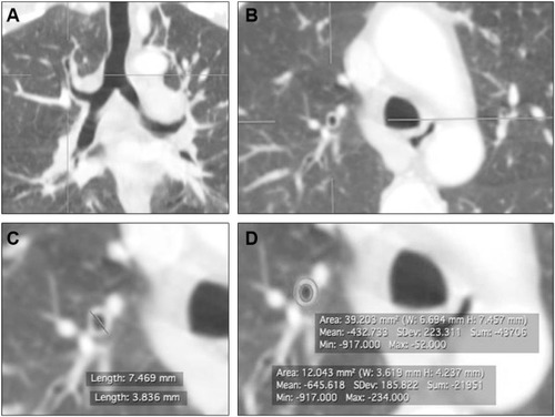 Figure 1 Bronchial wall thickness measurement in high-resolution CT scan.