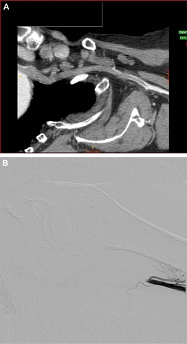 Figure 1 (A) Computed tomography angiogram of the left subclavian artery with thrombotic occlusion from the origin of the artery and (B) retrograde contrast injection through the introducer sheath demonstrates the end of the thrombotic occlusion.