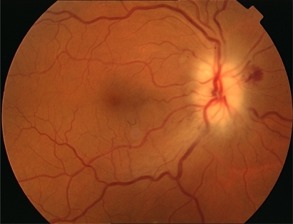 Figure 1 Swollen optic disc of the right eye with small hemorrhages.