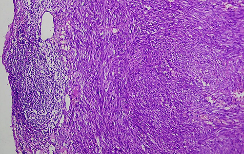 Figure 5 Under 20X magnifications, shows lymphoid tissue with a completely effaced architecture composed of vague interlacing fascicles of spindle cells along with extravasated RBCs. Subcapsular remnants of lymphoid aggregates are also noted.
