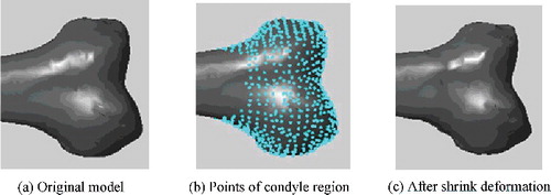 Figure 13. Deformation effect of femoral condyle. The condyle width was adjusted from 75.48 to 73.34 mm.