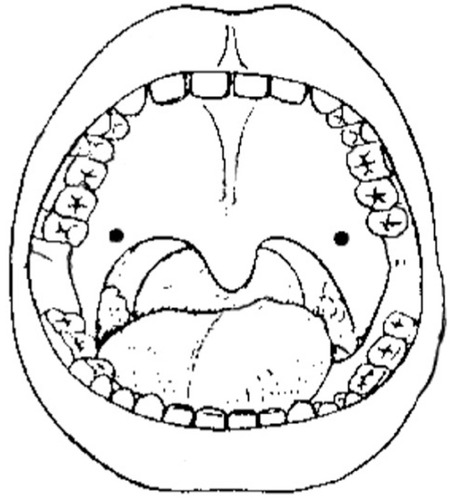 Figure 2 Sites of intraepithelial injections to the palatal velum.