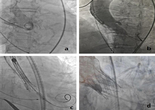 Figure 2 TAVR procedure. (a) Aortic root angiography; (b) Balloon predilatation; (c) Placement positioning; (d) Postoperative angiography.