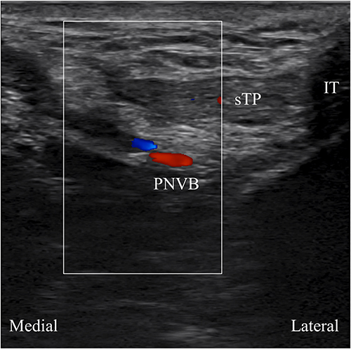 Figure 2 Pudendal neurovascular bundle (PNVB) in the color Doppler ultrasound image at the perineum.