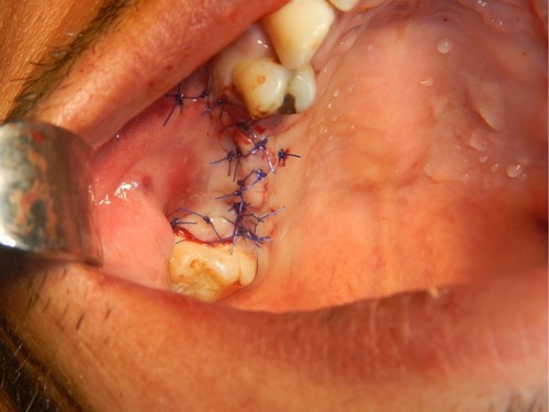 Figure 6 The double-layer flap was closed using mattress and single interrupted sutures with a free-tension flap and eversion to avoid wound dehiscence.