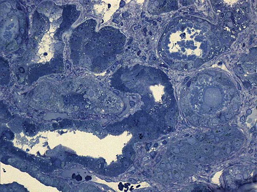 Figure 2. Light microscopic examination. Tubulointerstitial area. The proximal tubules showed epithelial flattening, loss of brush border, and intraluminal necrotic debris (toluidine blue ×400).