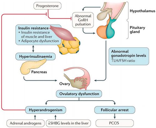 Figure 2 Summarized scheme of the pathophysiology of PCOS.