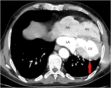 Figure 4 An axial CT scan image demonstrates the heart’s displacement into the left hemithorax and the total lack of pericardium along the left ventricular border (red arrow).