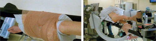 Figure 3 Well leg positioning on a fracture table: using a pillow sling.