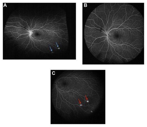 Figure 2 Ultra-widefield fluorescein angiogram of the left eye of a patient with Von Hippel-Lindau syndrome. (A) Optos® Optomap® (Optos PLC, Dunfermline, UK); (B and C) Heidelberg Spectralis® (Heidelberg Engineering, Heidelberg, Germany). The total retinal surface area visualized on a single-shot image was considerably greater with the Optos® Optomap® compared with the Heidelberg Spectralis®. Two retinal hemangioblastomas are noted in the inferotemporal quadrant (arrows in A and C). With the patient in primary gaze (A and B), only the Optos® Optomap®, and not the Heidelberg Spectralis®, clearly shows these two lesions (arrows in A). With the patient looking inferotemporally (C), the Heidelberg Spectralis® ultra-widefield module is able to capture the two retinal hemangioblastomas (arrows in C).