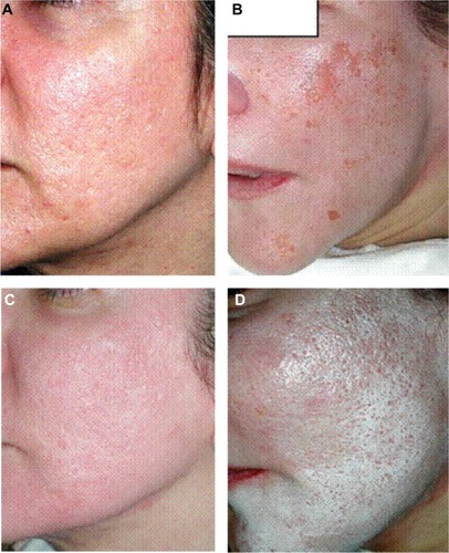 Figure 1 Treatment of acne scars with a phenol peeling.