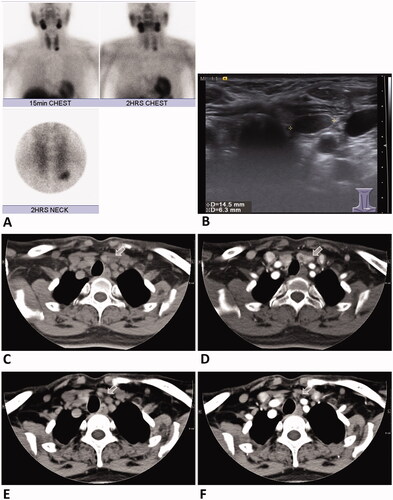 Figure 2. A 54-year-old female with primary hyperparathyroidism. Technetium (99mTC)-sestamibi scan (A) and US examination (B) revealed a hyperfunctional left lower parathyroid adenoma measuring 14.5 mm × 6.3 mm. CT scan of the parathyroid adenoma (arrow) without (C) and with contrast enhancement before RFA (D). CT scan without (E) and with contrast enhancement 1 year after RFA (F) showed total regression (arrow) of the left inferior parathyroid adenoma. Serum PTH and calcium levels were decreased and remained in the normal range at the 1-year follow-up. RFA: radiofrequency ablation; PTH: parathyroid hormone; US: ultrasound.