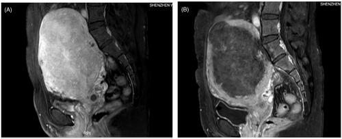 Figure 1. Contrast MRI obtained from a 41-year-old patient with adenomyosis who had failed to respond to drug therapies. (A) Contrast-enhanced MRI obtained before HIFU showed the enhancement of the adenomyosis. (B) MRI obtained one day after HIFU showed the non-perfused area of the adenomyotic lesion and endometrium.
