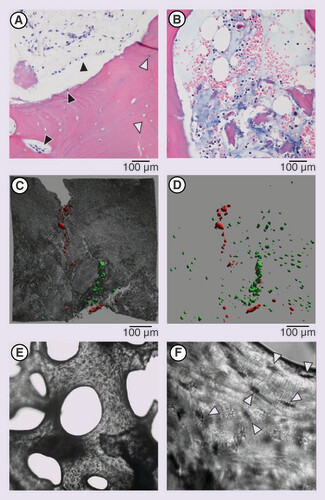 Figure 2. Assessment of cell abundance in Osteocel® as analyzed by histology, confocal microscopy and light microscopy. (A) Hematoxylin and eosin staining of decalcified fragments of Osteocel bone; compared with (B) control iliac crest bone; black filled arrows indicate presence of bone-lining cells, white filled arrows indicate embedded octeocytes. (C) Confocal microscopy indicating the presence of live (green) and dead (red) cells on the surface of Osteocel and (D) following the removal of bone reflected light signal showing more live cells embedded in the bone matrix (osteocytes), similar to (A). (E) Abundant osteocytes stained with Crystal Violet, original magnification ×40 and (F) ×100 indicated by white filled arrows.