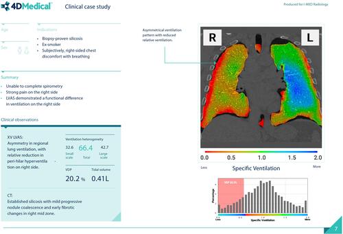 Figure 4 Representative clinical report of lung ventilation with coronal map, histogram showing specific ventilation and quantitation of ventilation heterogeneity, courtesy of 4D Medical.