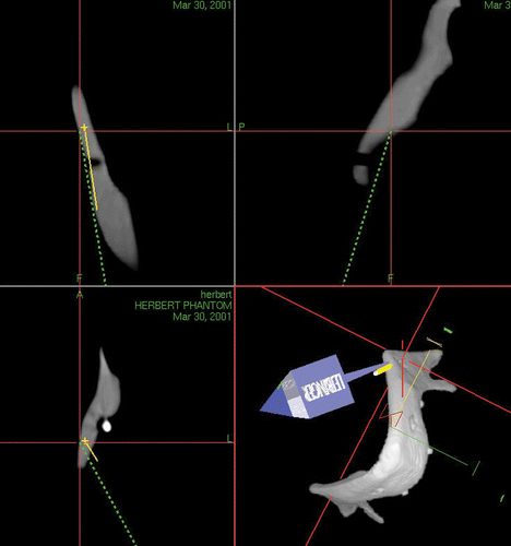 Figure 7. Corresponding view of the workstation monitor showing the preoperatively planned drilling path (yellow line) and the actual path of the drill wire (green line); the coronal layer with parallel follow-up along the preoperatively planned drilling pathway to the target (upper left); the sagittal layer (upper right); the axial layer (lower left); and the 3D depiction (lower right). [Color version available online.]