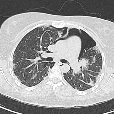 Figure 1 Chest computed tomography (CT) in the axial plane showing pneumomediastinum outlining the heart and other mediastinal structures. The lung parenchyma shows multiple bilateral peripheral and subpleural areas of ground-glass opacities.