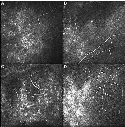 Figure 2 In vivo confocal microscopy images of the subbasal nerve plexus for patient 7 taken at 50µm depth- Pre op presence of one main nerve fibre (arrow) (A); one main nerve fibre (arrow) and nerve branches (dotted arrow) at 3 month (B); one main nerve fibre (arrow) and multiple nerve branches (dotted arrow) at 6 month (C); three main nerve fibres and multiple nerve branches at 12 month (D) after corneal neurotisation surgery (-: main nerve, –: nerve branches showing nerve regeneration).