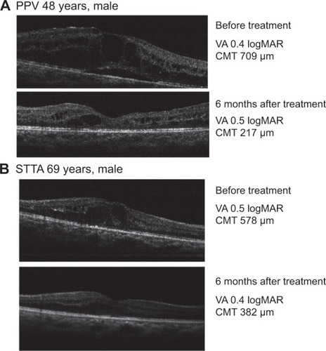 Figure 1 Representative cases of DME treated with PPV or STTA.