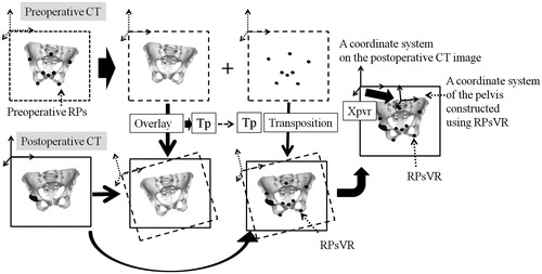 Figure 3. A computer matching method used as a gold standard for constructing a bony coordinate system on postoperative CT images. These examples are for a pelvic coordinate system. The pelvic model on the preoperative CT image was overlaid exactly on the postoperative CT image using the volume registration method. The rotation and translation of the preoperative CT coordinate system during this matching process was recorded as an affine matrix (Tp). The preoperative RPs on the preoperative image were converted on the postoperative image as RPsVR (reference points for the computer matching method), maintaining the preoperative special relationship to the pelvis by calculating the Tp. The pelvic coordinate system that was constructed using the RPsVR was defined by an affine matrix (Xpvr) in the coordinate system of the postoperative CT image.