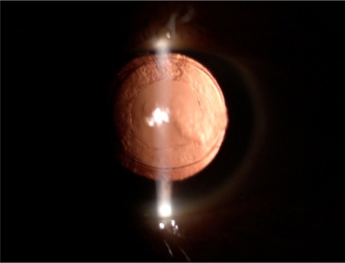 Figure 4 Anterior segment photography of the right eye after Nd:YAG capsulotomy.