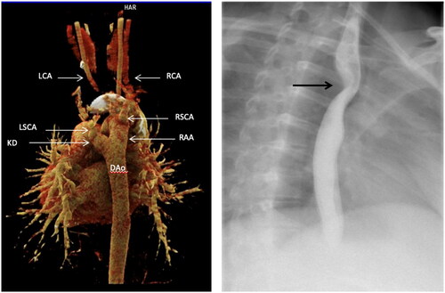Figure 1. Right: 3D reconstruction of the computed tomography angiography of the aortic arch and the descending aorta. Posterior view of the right-sided aortic arch (RAA) with the origin of the right subclavian artery (RSCA) and the common origin of Kommerell diverticulum (KD) and the aberrant retro-oesophageal left subclavian artery (LSCA) and the right- (RCA) and left carotid arteries (LCA). DAo: descending aorta. Left: Barium swallow contrast radiography of the oesophagus showing a posterior oesophageal compression [Citation13] (arrow).
