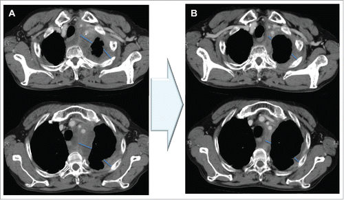 Figure 2. Computed tomography shows S-1+CBDCA treatment course.