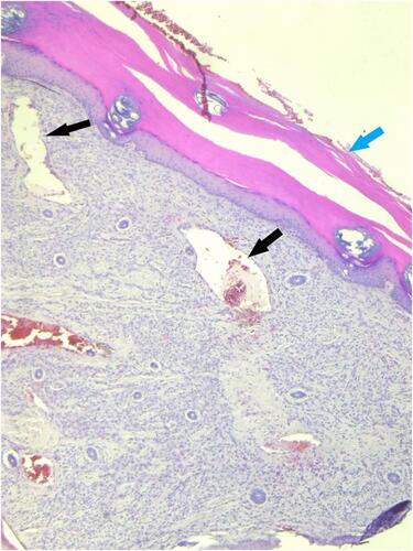 Figure 3 Skin biopsy: Low-power microscopy showing hyperkeratosis of epidermis (blue arrow) and multiple ectactic capillaries in the dermis (black arrows).