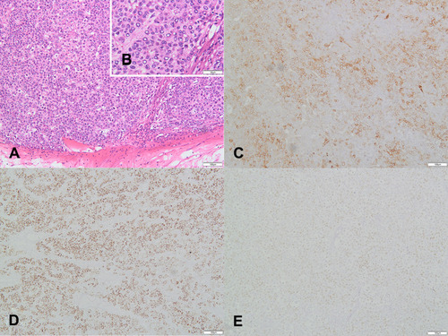 Figure 3 Pathological findings for case 2: (A) (H&E×100), (B) (H&E×200),Microscopically, tumor cells are large and polygonal, with abundant and eosinophilic cytoplasm. The nuclei lightly stained are round, elliptic or irregular in shape, with inconspicuous nucleoli. Some of the nuclei are vacuolated with chromatin squeezed under the thickened nuclear membrane. The nuclei are highly heteromorphic, with active mitoses and some of the cells are binuclear or multinucleate. The tumor has an infiltrative growth and is poorly demarcated from normal tissue. (C) positive stain for AFP(×100). (D) positive stain for Hepatocyte-paraffin 1(×100). (E) negative stain for SALL-4(×100). Besides, we got immunohistochemical analysis as follows: PAX8(-), P53(-), P16(-), ER(-), PR(-).