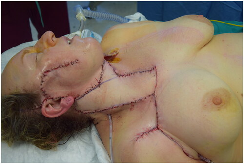 Figure 3. Immediate post-operative.