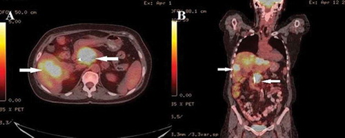 Figure 3. PET-CT scan showing large hypermetabolic lesion in the head of pancreas, multiple hypermetabolic hepatic lesions and one hypermetabolic right retroperitoneal lymph node in (a) axial view and (b) coronal view (arrows).