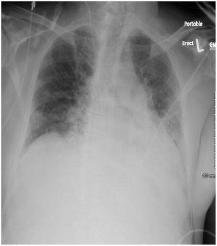 Figure 2. Chest Xray on admission.