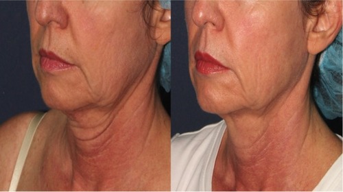 Figure 1 XX-year-old female; one MFU-V treatment to full face and full neck; total treatment lines are XXX; 8 months later.