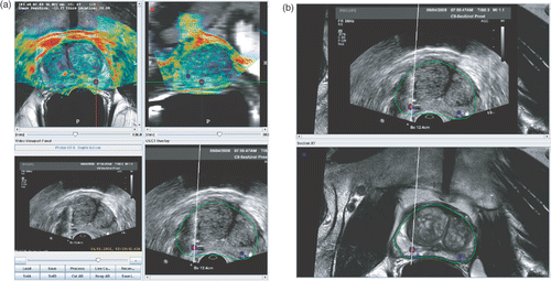 Figure 7. Screenshots of fused MRI/TRUS image guidance. (a) T2-weighted MRI fused with reference ultrasound volume (color map), along with the real-time ultrasound and target information. (b) Corresponding real-time ultrasound (top) and MRI MPR views (bottom) at the time of needle deployment. [Color version available online.]