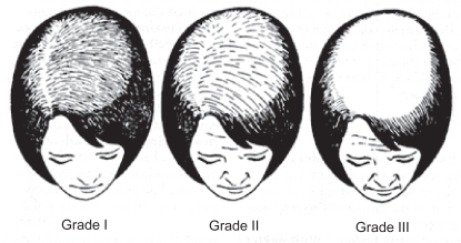 Figure 1 CitationLudwig scale (1977).Grade I: Perceptible thinning of the hair on the crown, limited in the front by a line situated 1–3 cm behind the frontal hair line.Grade II: Pronounced rarefaction of the hair on the crown within the area seen in Grade I.Grade III: Full baldness (total denudation) within the area seen in Grades I and II.