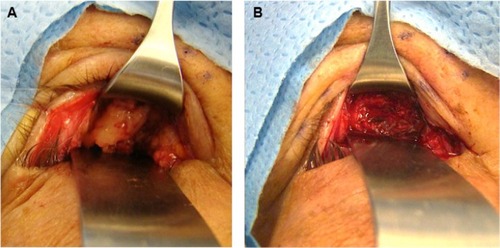 Figure 3 (A) Inferior fornix approach showing a 3.5 cm ×1.5 cm well-defined grayish mass in the anteroinferior left orbit. (B) Operative photograph of inferior fornix approach, demonstrating complete removal of mass.