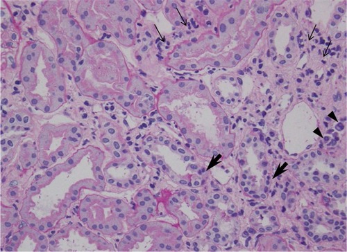 Figure 1 Histopathology of kidney biopsy specimen shows focal interstitial infiltration of lymphocytes (small arrows) and plasma cells (arrow heads) in the renal cortex as well as in the corticomedullary junction, along with the mild tubulitis with infiltrating lymphocytes (large arrows; PAS, ×200).