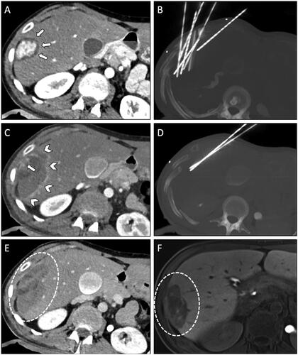 Figure 1. Case of a 35-year-old woman with a β-Catenin positive HCA in liver segment V/VI referred for SRFA. (A) Pre-interventional CT scan in the late arterial phase revealed a 42 mm enhancing nodule in the subcapsular region (white arrows). (B) Maximum intensity projection (MIP) of the non-enhanced control CT-scan with the placement of seven coaxial needles. (C) Post-interventional CT scan in the late arterial phase with coagulation zone (white arrowheads) and visible residual vital tumor tissue with contrast enhancement (white arrow). (D) MIP of non-enhanced CT scan of the immediate re-ablation of the residual tumor using two coaxial needles in the same ablation session. (E) Final post-interventional CT-scan in portal venous phase with correspondingly large coagulation zone (white dashed circle). (F) MRI in the hepatobiliary phase with a shrinking coagulation zone was performed at a one-year follow-up (white dashed circle).