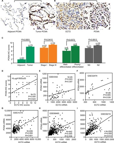 Figure 5 ECT2 expression correlated with PCNA expression.Notes: (A) Representative images of IHC staining of PCNA; (B) representative images of IHC staining of PCNA and ECT2 in the same lung cancer tissues; (C) IHC scores of PCNA in lung cancer; (D) the correlation between ECT2 and PCNA based on protein expression; (E) based on the mRNA level of the GSE4342 cell line; (F) GSE32474 cell line; (G) GSE31210 cell line; (H) GSE68465 cell line; (I) GSE30219 cell line. N−, lymph node negative; N+, lymph node positive.Abbreviations: IHC, immunohistochemical staining; PCNA, proliferating cell nuclear antigen; ECT2, epithelial cell transforming sequence 2; HR, hazard ratio; ADC, adenocarcinoma; SQC, squamous cell lung cancer.