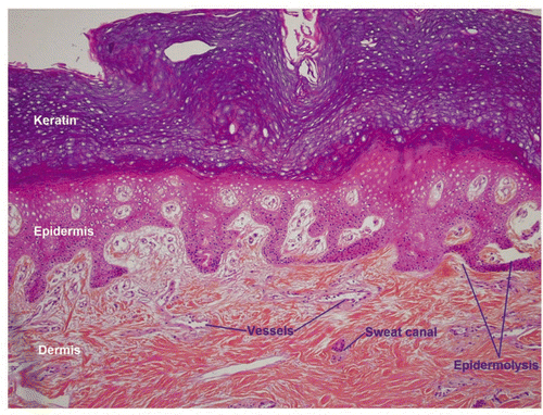 Figure 11 At higher magnification one sees spaces at the dermal-epidermal junction that indicate the onset of a foreseeable epidermolysis.