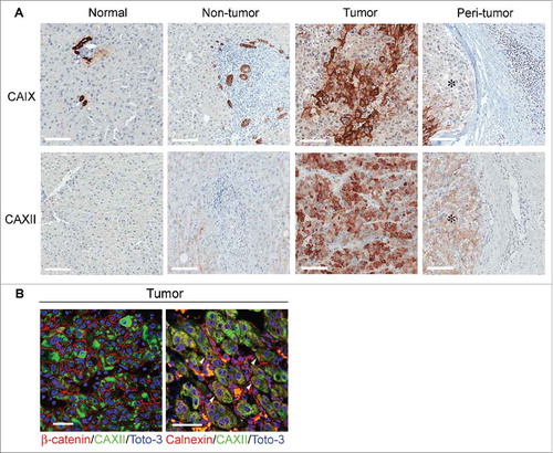 Figure 2. Expression and cellular distribution of CAIX and CAXII in liver tissues. (A) Representative images of immunohistochemical staining for CAIX and CAXII in normal and matched non-tumor, tumor and peri-tumor liver tissues. Peri-tumor tissue was identified as areas adjacent to tumor nodules enriched in immune infiltrating cells. Membranous staining of CAIX was detectable in bile ductular cells in normal and non-tumor tissues and in malignant hepatocytes. CAXII was expressed in the cytoplasm of malignant hepatocytes. No positive staining was evident in the inflammatory cells infiltrating the peri-tumor areas. *Identifies tumor area in peri-tumor sections. Representative images with scale bars = 100 μm. (B) Confocal laser scanning micrographs of immunofluorescent staining with anti-CAXII (green), anti-β-catenin (red) and anti-calnexin (red) in formalin-fixed, paraffin-embedded HCC tissues. Nuclei were stained with Toto-3 (blue). In the left panel, CAXII displays cytoplasmic expression without any co-localization with the membranous staining of β-catenin (red). In the right panel, the white triangle indicates the co-localization of CAXII and calnexin. Scale bars = 50 μm.